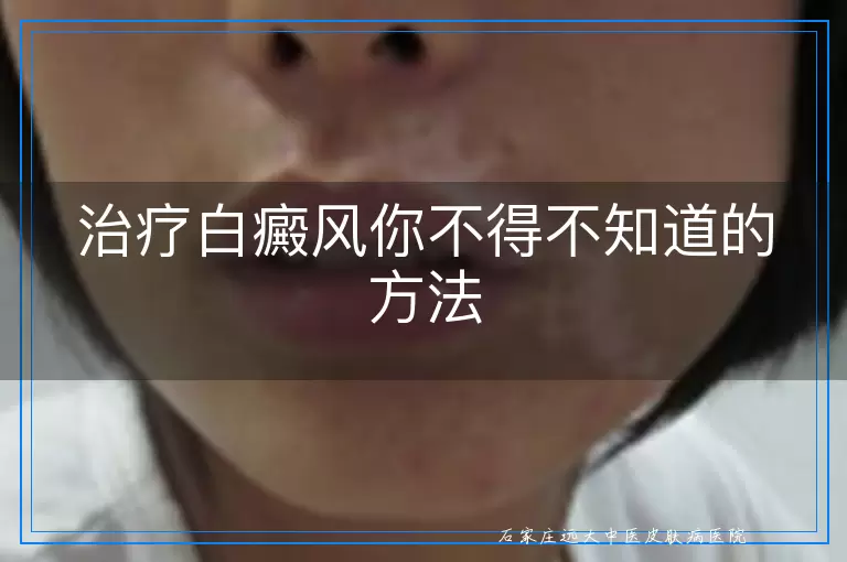 治疗白癜风你不得不知道的方法