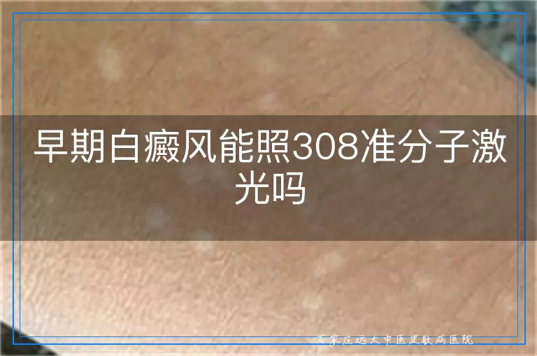 早期白癜风能照308准分子激光吗