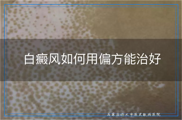 白癜风如何用偏方能治好