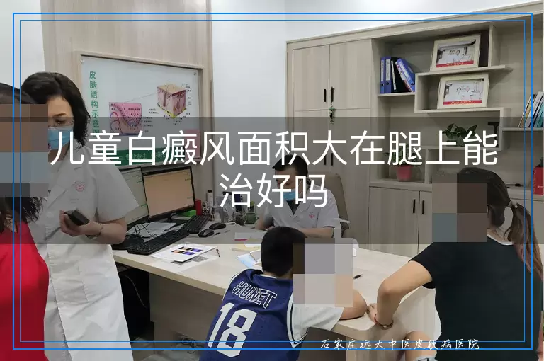 儿童白癜风面积大在腿上能治好吗
