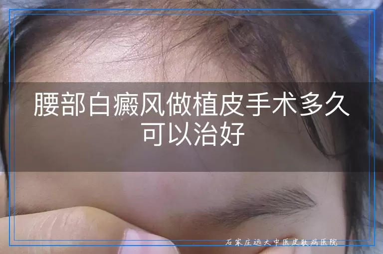 腰部白癜风做植皮手术多久可以治好