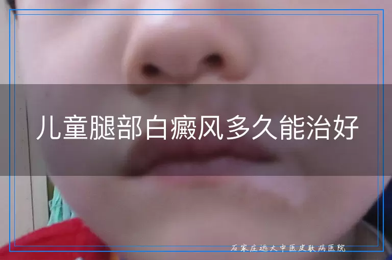 儿童腿部白癜风多久能治好