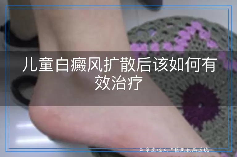 儿童白癜风扩散后该如何有效治疗