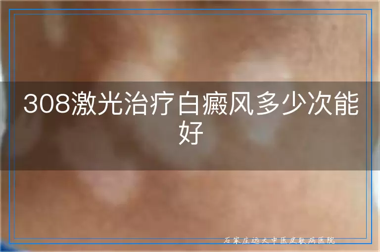 308激光治疗白癜风多少次能好
