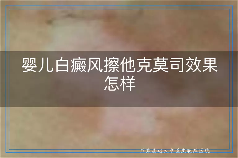婴儿白癜风擦他克莫司效果怎样
