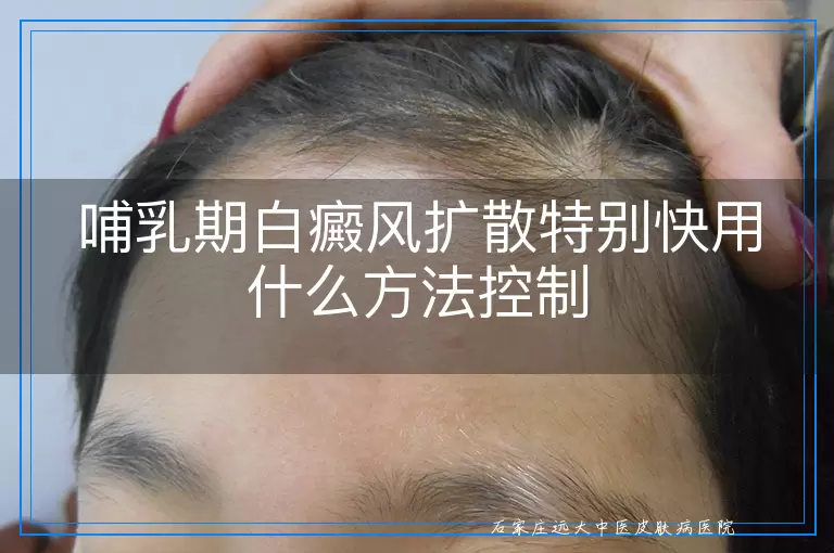 哺乳期白癜风扩散特别快用什么方法控制