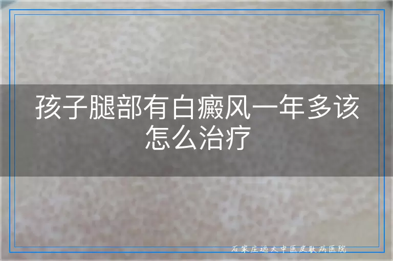 孩子腿部有白癜风一年多该怎么治疗