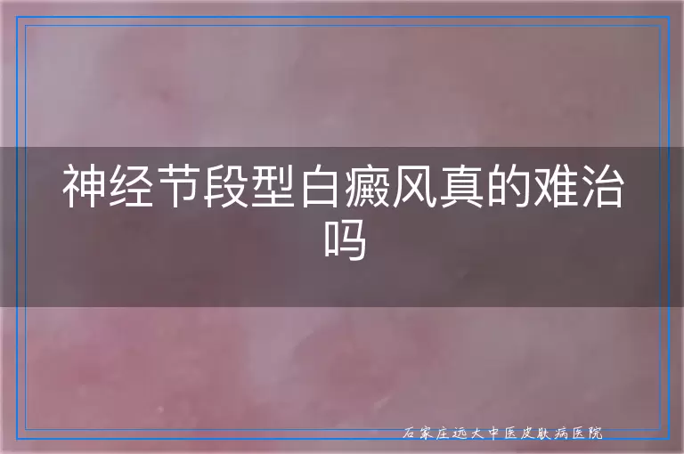 神经节段型白癜风真的难治吗