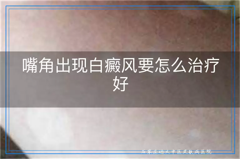 嘴角出现白癜风要怎么治疗好