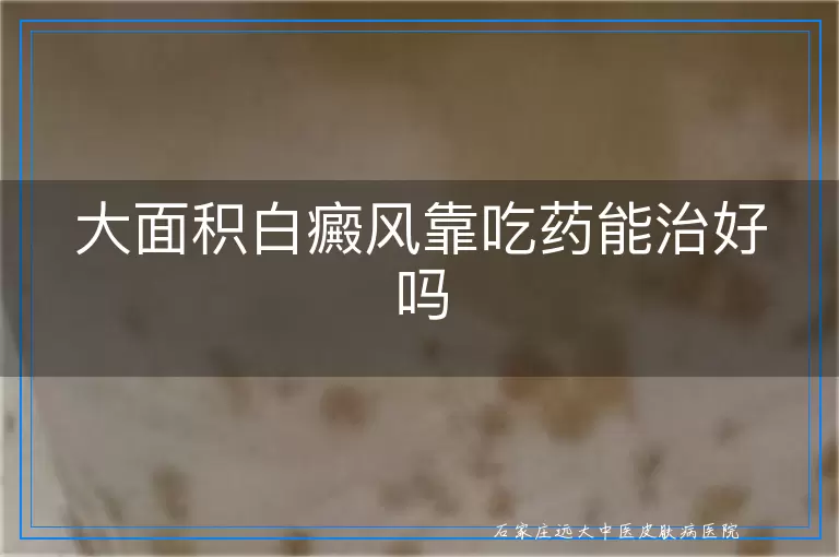 大面积白癜风靠吃药能治好吗