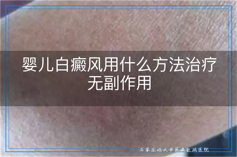 婴儿白癜风用什么方法治疗无副作用