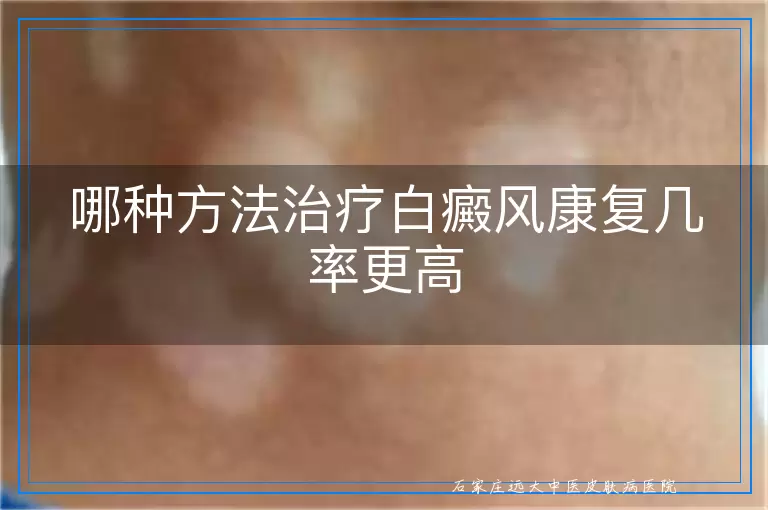 哪种方法治疗白癜风康复几率更高