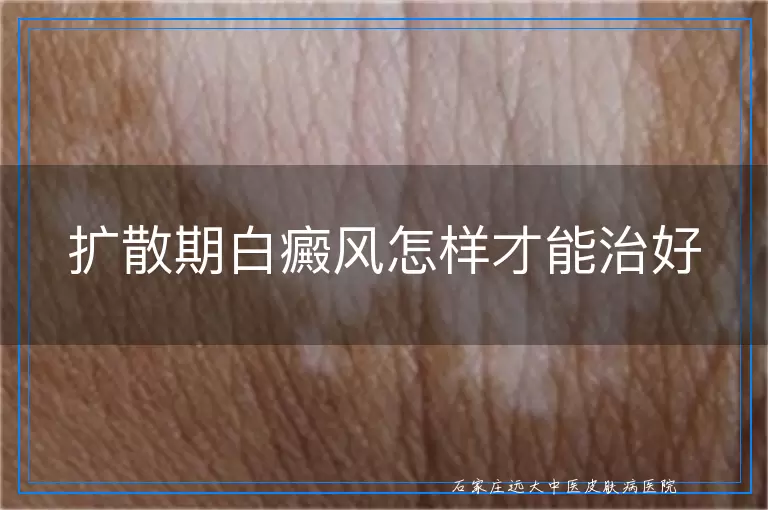 扩散期白癜风怎样才能治好