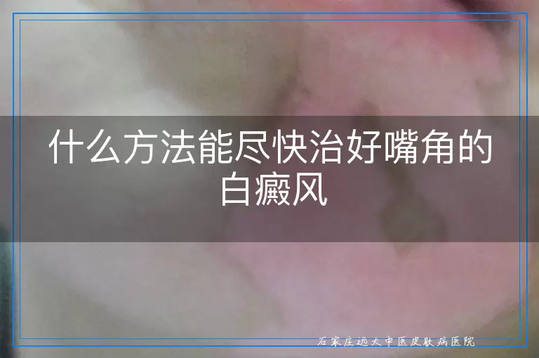 什么方法能尽快治好嘴角的白癜风