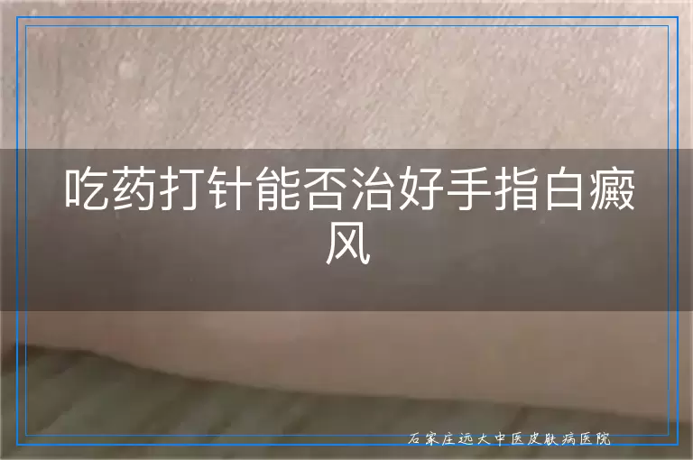 吃药打针能否治好手指白癜风