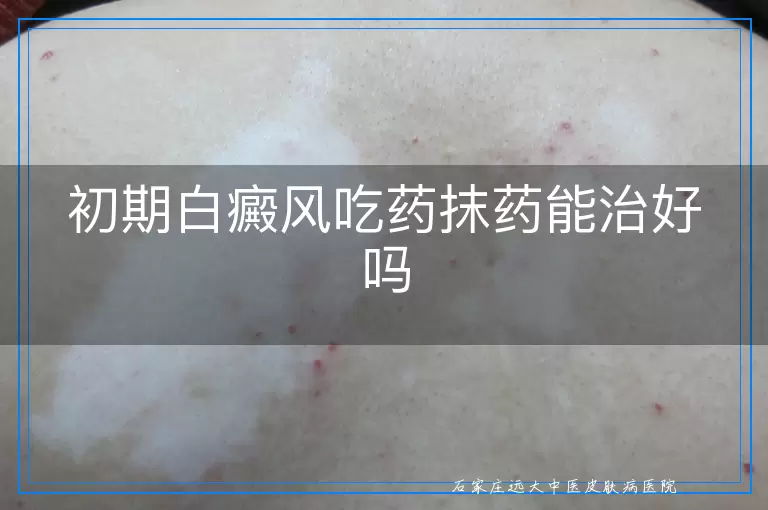 初期白癜风吃药抹药能治好吗