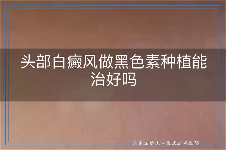 头部白癜风做黑色素种植能治好吗