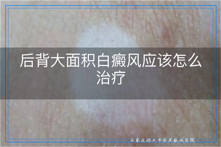 后背大面积白癜风应该怎么治疗
