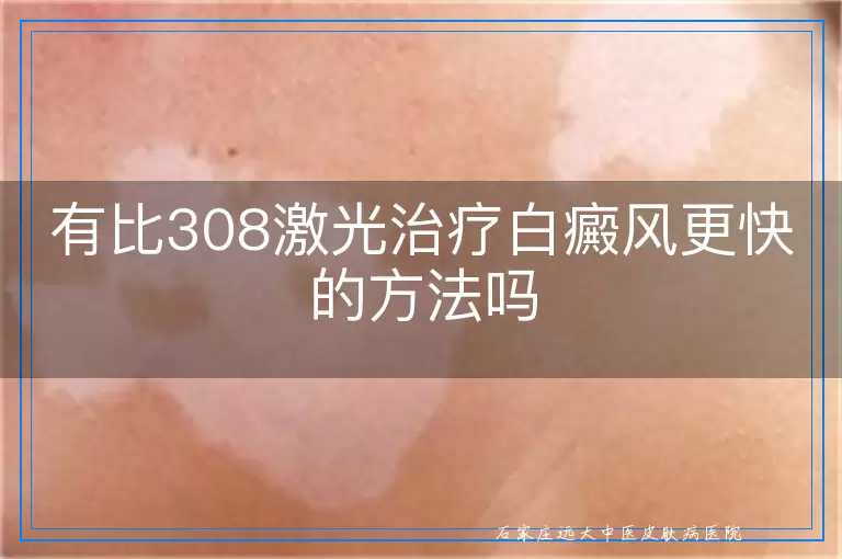 有比308激光治疗白癜风更快的方法吗