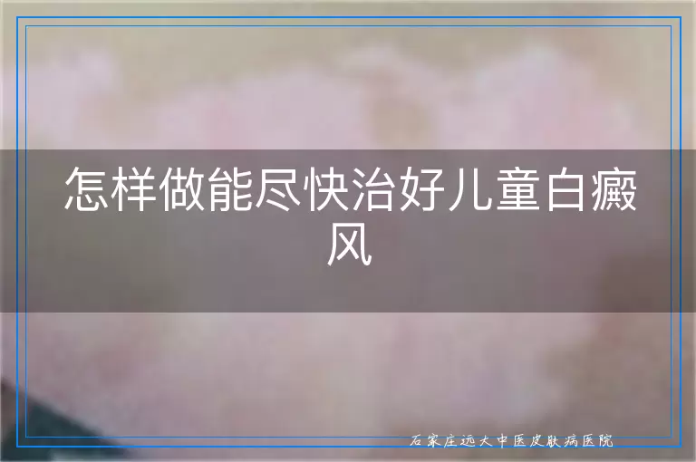 怎样做能尽快治好儿童白癜风