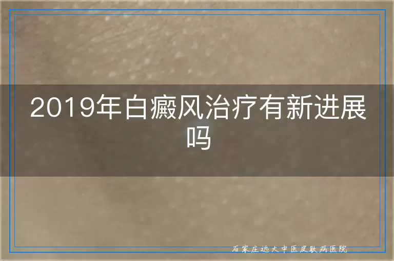 2019年白癜风治疗有新进展吗
