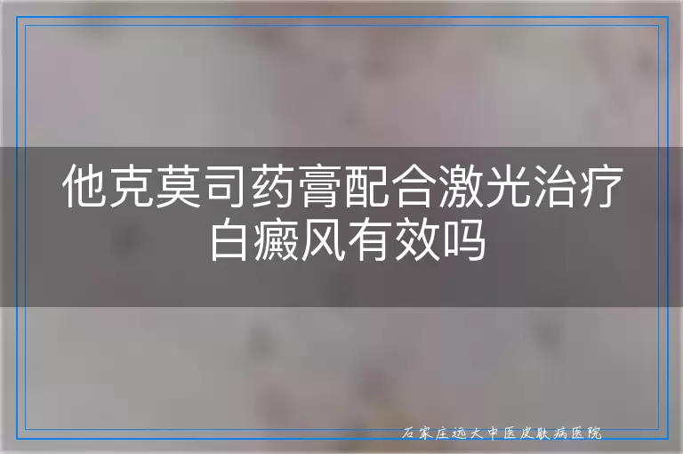 他克莫司药膏配合激光治疗白癜风有效吗