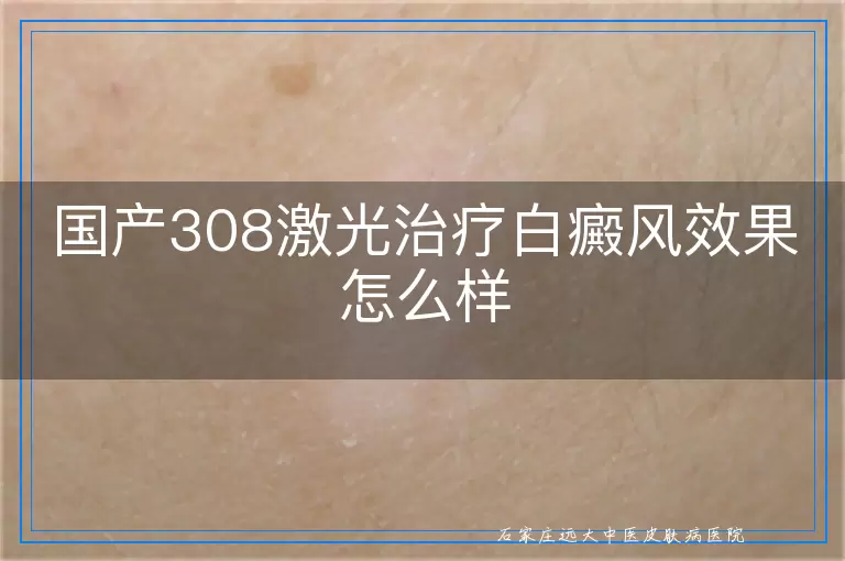 国产308激光治疗白癜风效果怎么样