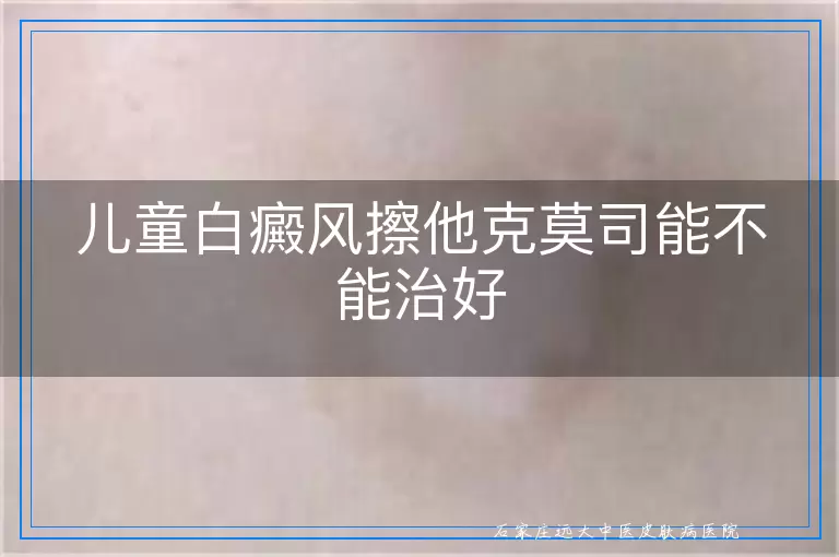儿童白癜风擦他克莫司能不能治好