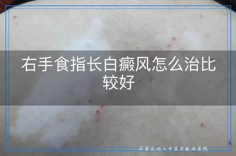 右手食指长白癜风怎么治比较好