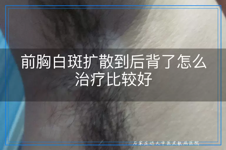 前胸白斑扩散到后背了怎么治疗比较好