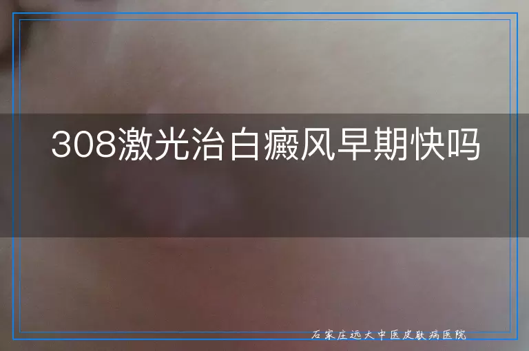 <strong>308激光治白癜风早期快吗</strong>
