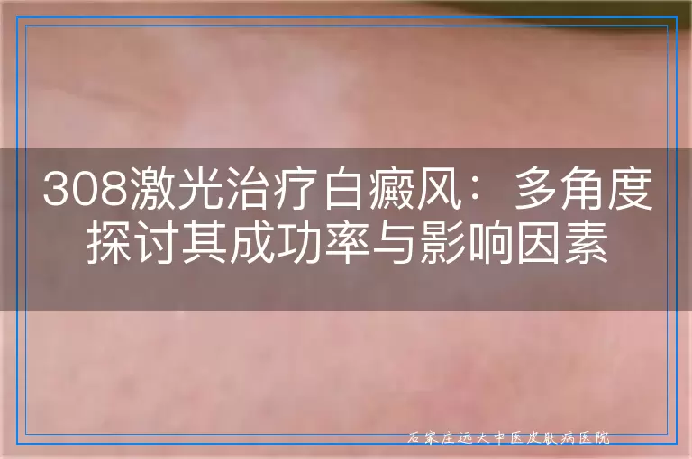 308激光治疗白癜风：多角度探讨其成功率与影响因素