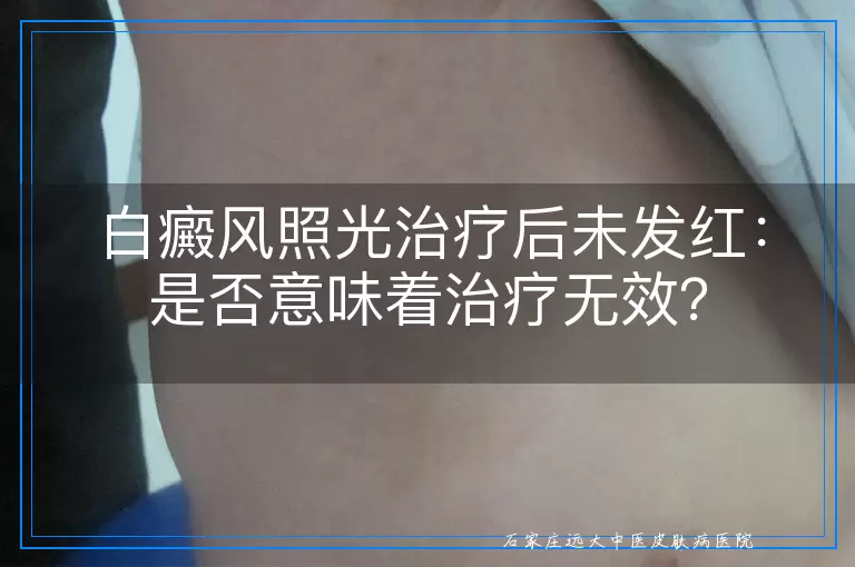 白癜风照光治疗后未发红：是否意味着治疗无效？