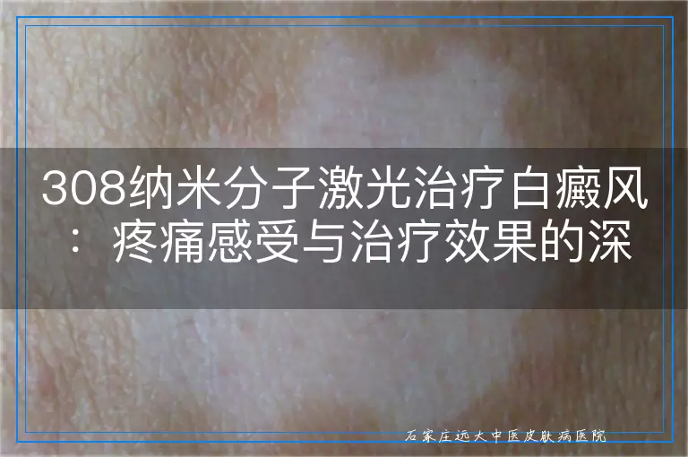 308纳米分子激光治疗白癜风：疼痛感受与治疗效果的深度剖析