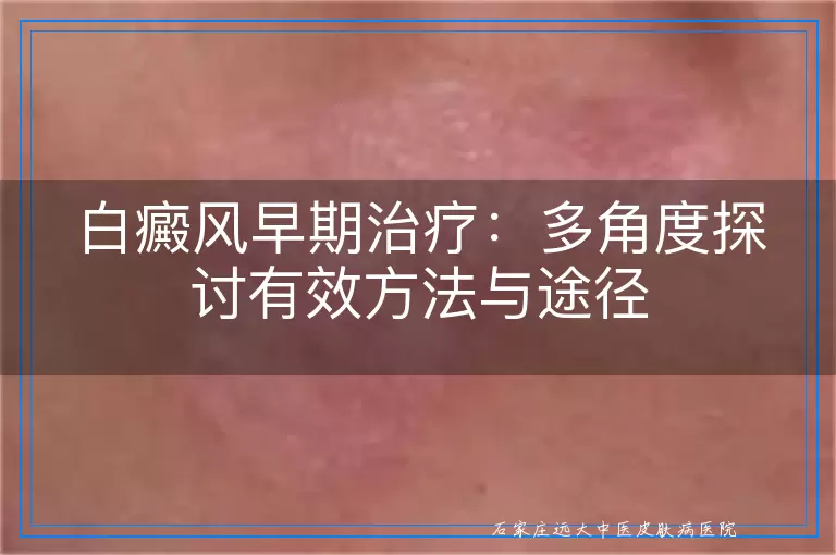 白癜风早期治疗：多角度探讨有效方法与途径