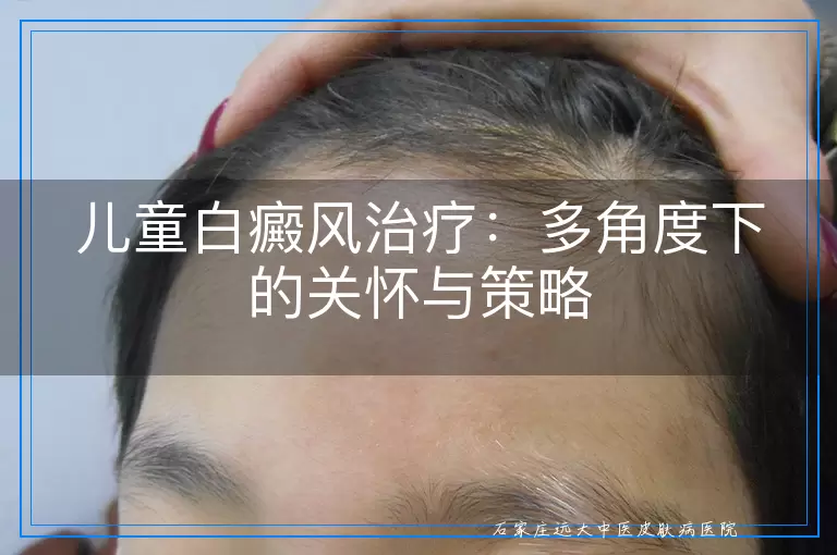 儿童白癜风治疗：多角度下的关怀与策略