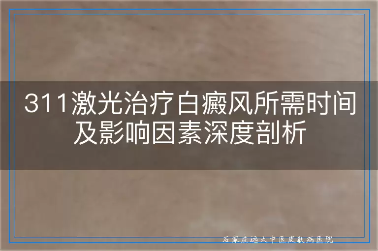 311激光治疗白癜风所需时间及影响因素深度剖析