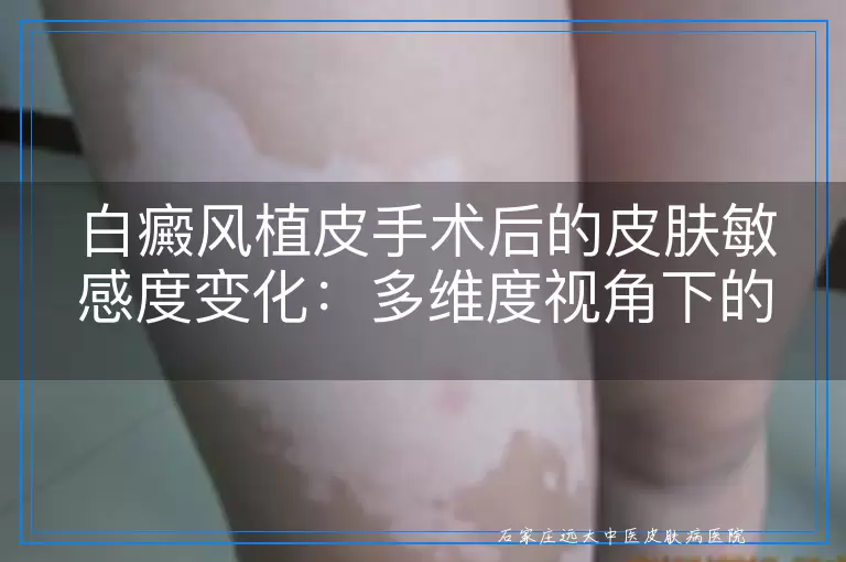白癜风植皮手术后的皮肤敏感度变化：多维度视角下的探讨