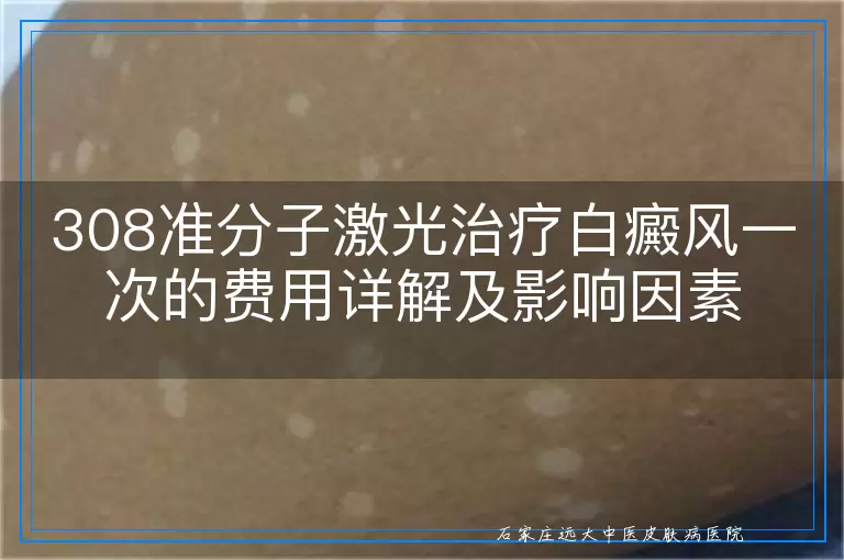 308准分子激光治疗白癜风一次的费用详解及影响因素