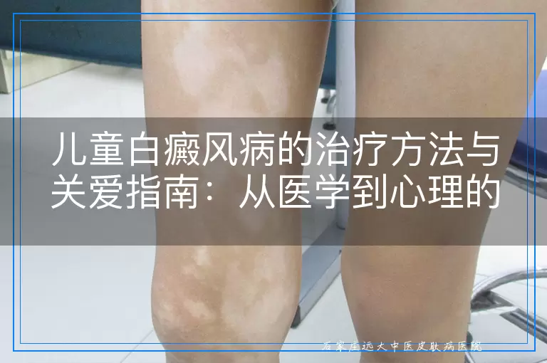 儿童白癜风病的治疗方法与关爱指南：从医学到心理的全方位呵护
