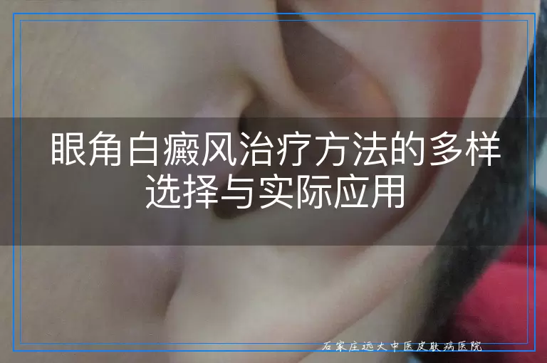 眼角白癜风治疗方法的多样选择与实际应用