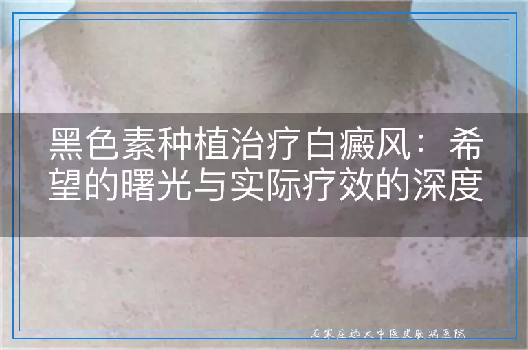 黑色素种植治疗白癜风：希望的曙光与实际疗效的深度探讨