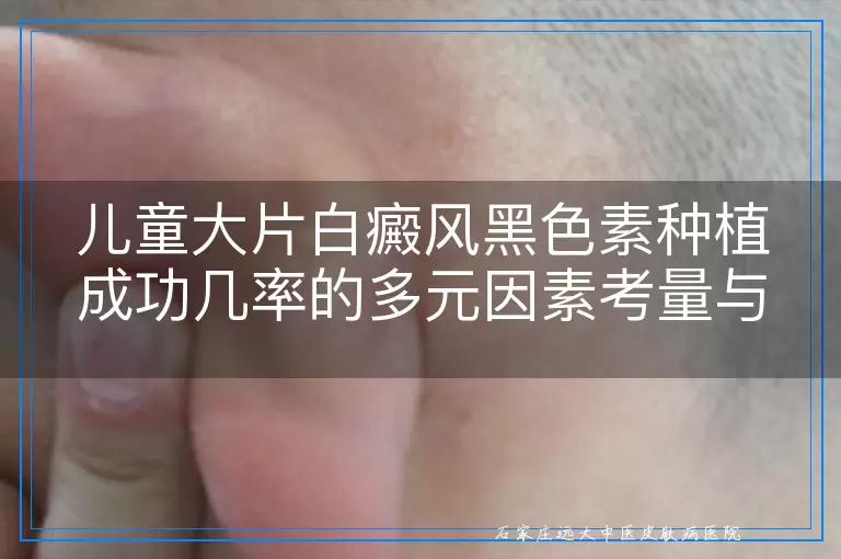 儿童大片白癜风黑色素种植成功几率的多元因素考量与实例探讨