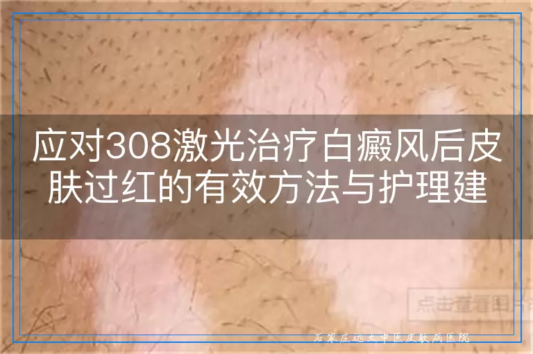 应对308激光治疗白癜风后皮肤过红的有效方法与护理建议