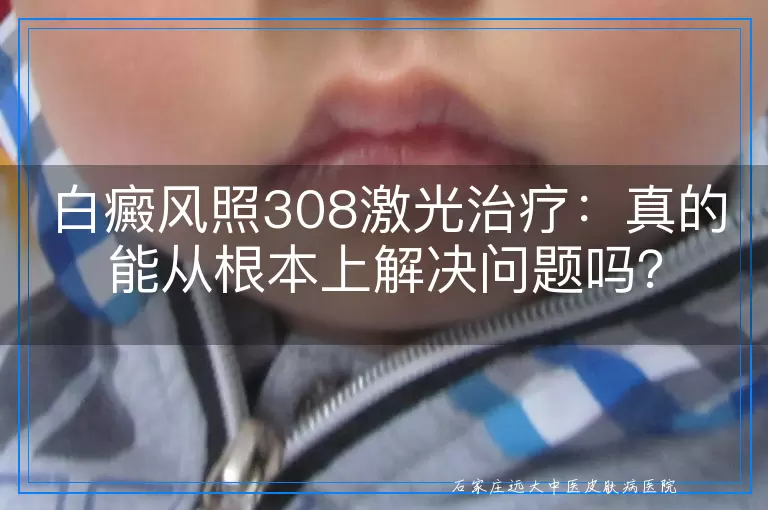 白癜风照308激光治疗：真的能从根本上解决问题吗？