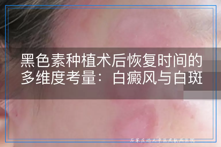 黑色素种植术后恢复时间的多维度考量：白癜风与白斑患者的实际经历
