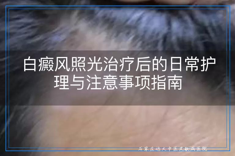 白癜风照光治疗后的日常护理与注意事项指南