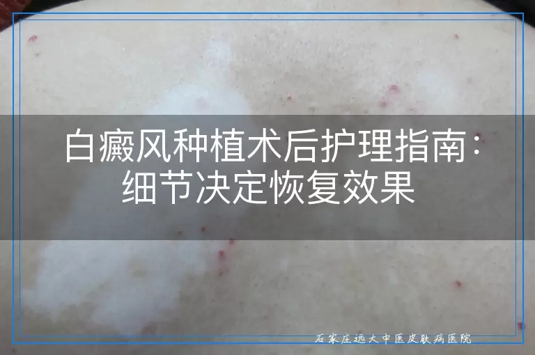 白癜风种植术后护理指南：细节决定恢复效果