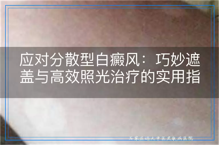 应对分散型白癜风：巧妙遮盖与高效照光治疗的实用指南