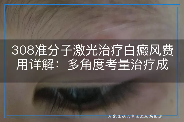 308准分子激光治疗白癜风费用详解：多角度考量治疗成本